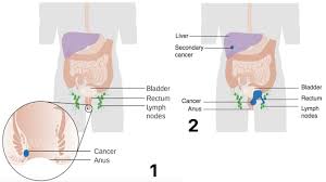 Anus Cancer Treatment in Electronic City